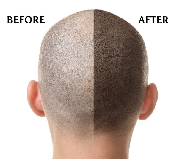 How Does Scalp Micropigmentation Work?