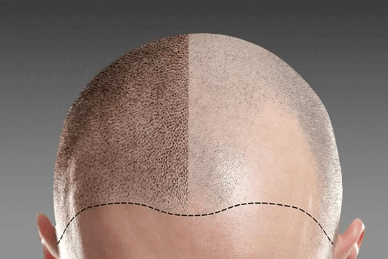 Scalp Micropigmentation (SMP): All You Need To Know Before You Go